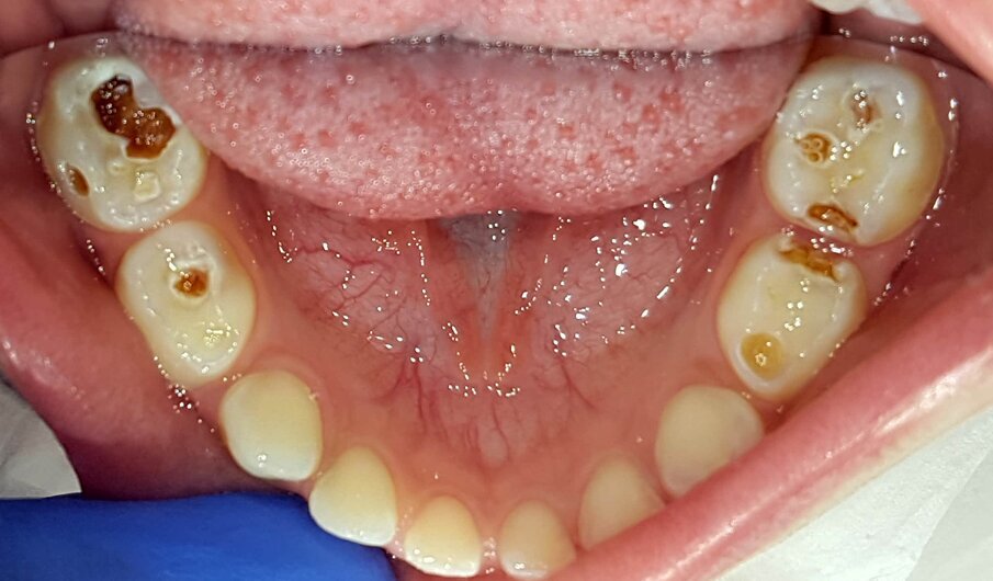 Afbeelding 6e. Cariëslaesies vrijgelegd en SDF aangebracht. Evaluaties van de zelfzorg bepalen de balans tussen causale therapie en symptoombestrijding.