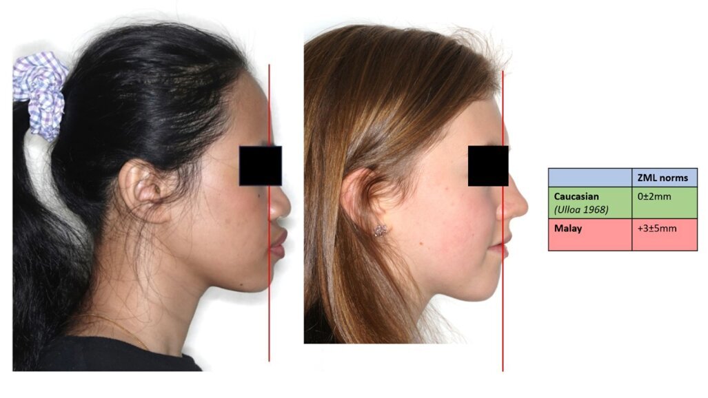 Zero meridian line norms in Malaysian Malay female adults