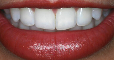 La eficacia de la técnica asociada en el aclaramiento dental