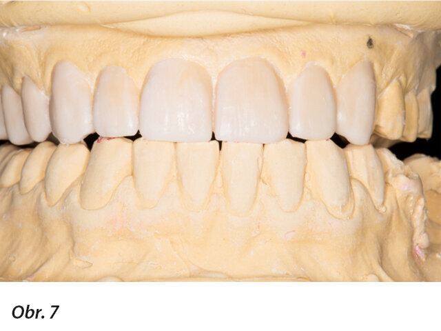 Funkční analýza wax-upu