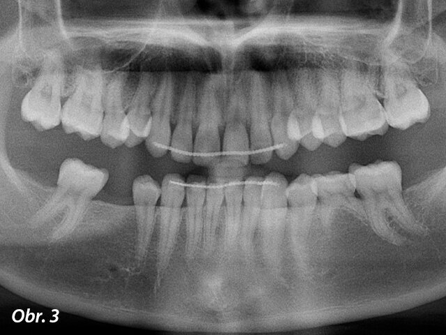 Panoramatický RTG snímek pořízený pomocí rentgenu Planmeca Promax 2D ukázal chybějící stálé zuby.