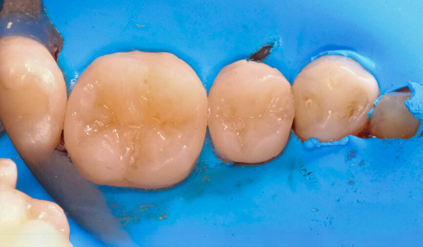 Fig. 4: Rubber fragments on the composite can be spread over the restoration surface using a fine nylon brush, polishing each fissure and pit.