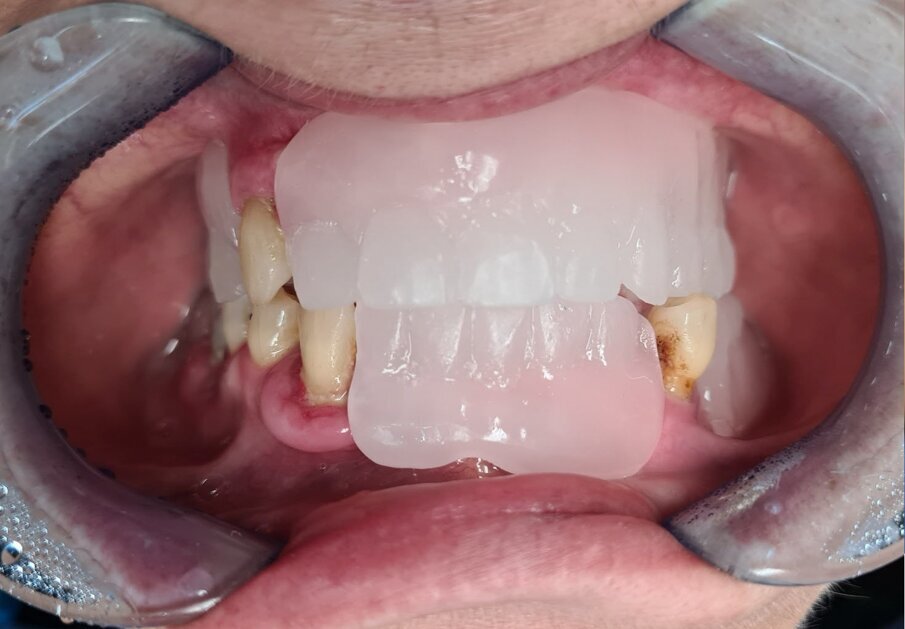 Fig. 5_Dima radiologica bariata per TAC.