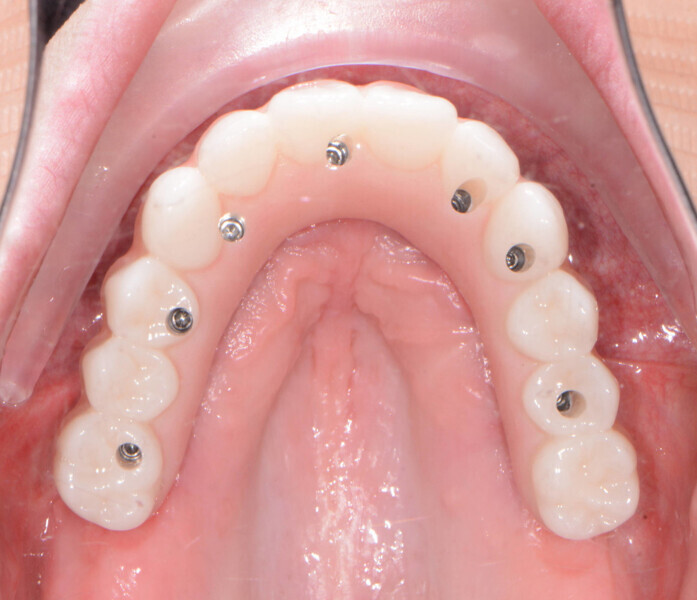 Fig. 18: Post-op occlusal view.