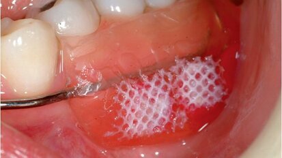 Les sucres extrinsèques n'apportent pas une différence significative sur les effets de déminéralisation dentaire