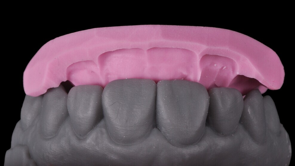 Palatal silicone index produced over the wax-up model with putty silicone material to allow for the build-up of the palatal wall and the layering of the dentine core by hand.