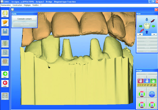 Fig. 11b: Preparation of vital teeth #31 to 42 bridge abutment (a). Digital impressions (CEREC 3.85) (b).