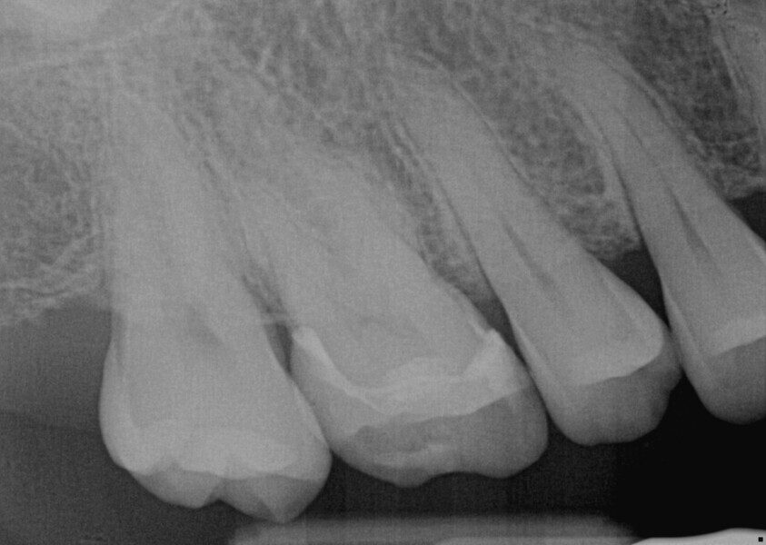 Fig. 18: Periapical radiograph of the luted inlay, demonstrating good marginal adaption interproximally.