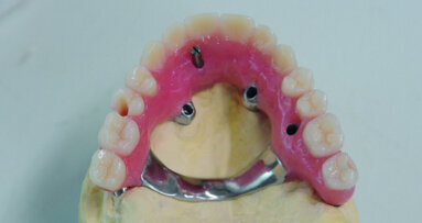 Implantologie basale, activation ostéogénique, mise en charge immédiate : clinique / « dogmes »