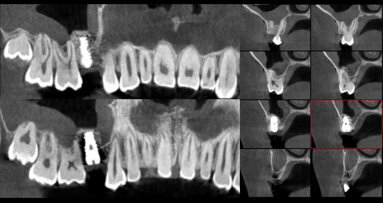 Augmentace sinu a současné zavedení implantátu za použití jednofázové sendvičové techniky