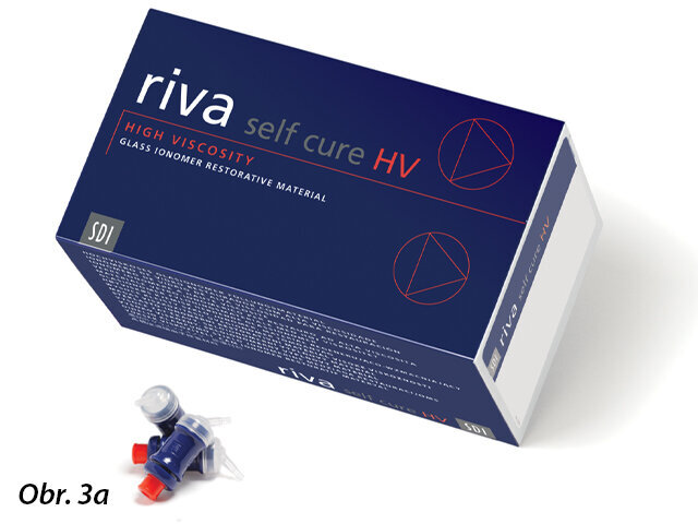 Příklady skloionomerů: Riva self cure (SDI) a EQUIA Forte (GC) – bioaktivní materiály, které remineralizují