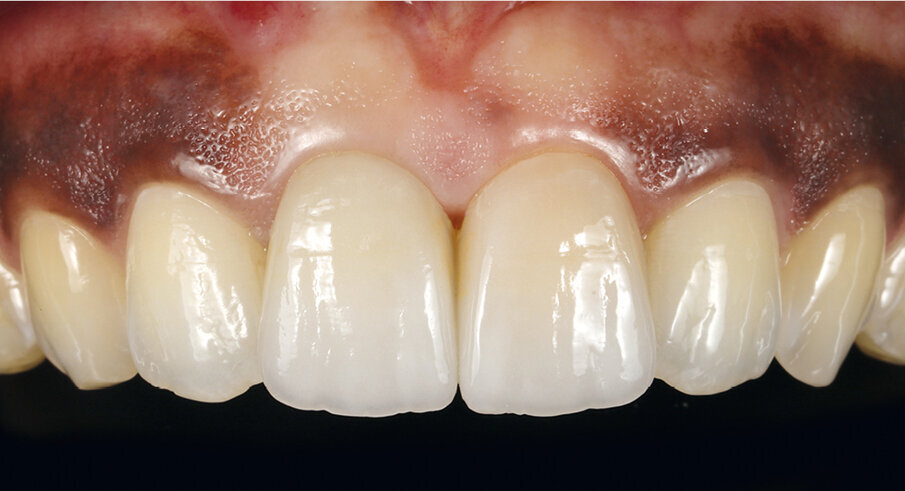 Fig. 21: The 3-year check-up did not show signs of ageing.