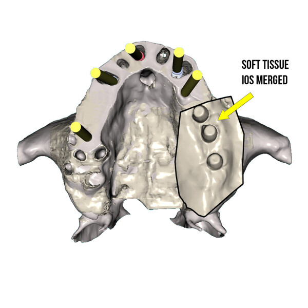 Fig. 10a: Occlusal view of the segmented maxillary arch showing the planned implant positions and yellow abutment projections.
