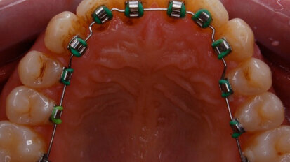 Cosmesi ortodontica con una apparecchiatura linguale 2D. Indicazioni, vantaggi e limiti