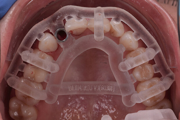 Fig. 11. Drill template and implant after insertion