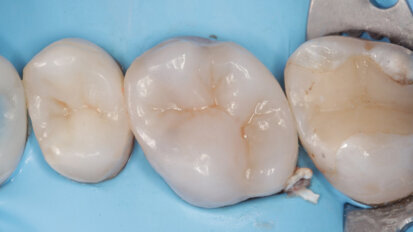 Direct cuspal coverage with resin composite