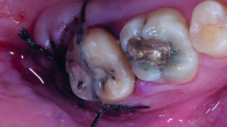 How to give a second life to third molars: A case series with follow-up