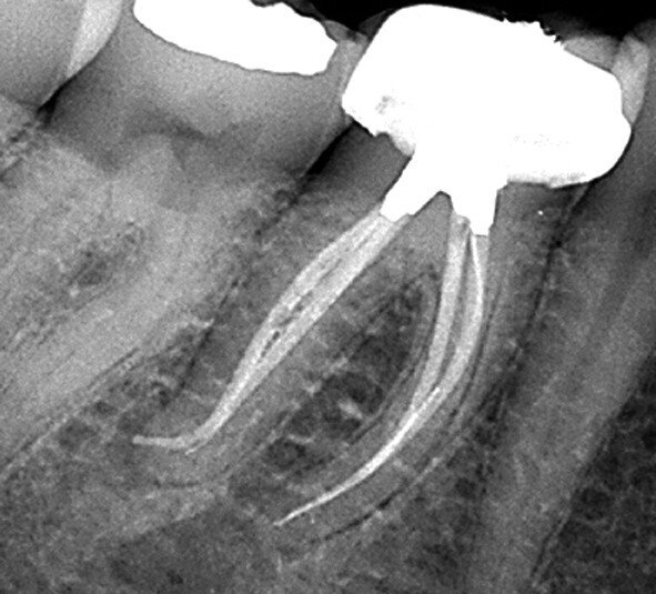 Fig. 9 : Cette molaire inférieure a été traitée au travers d’un orifice d’accès de moins de 2 mm2, préparé juste derrière l’arête triangulaire de la cuspide MV. À noter le traitement final des tiers apicaux des quatre canaux, malgré la dimension réduite de l’orifice. (Photo : fournie par le Dr Charles Maupin) 