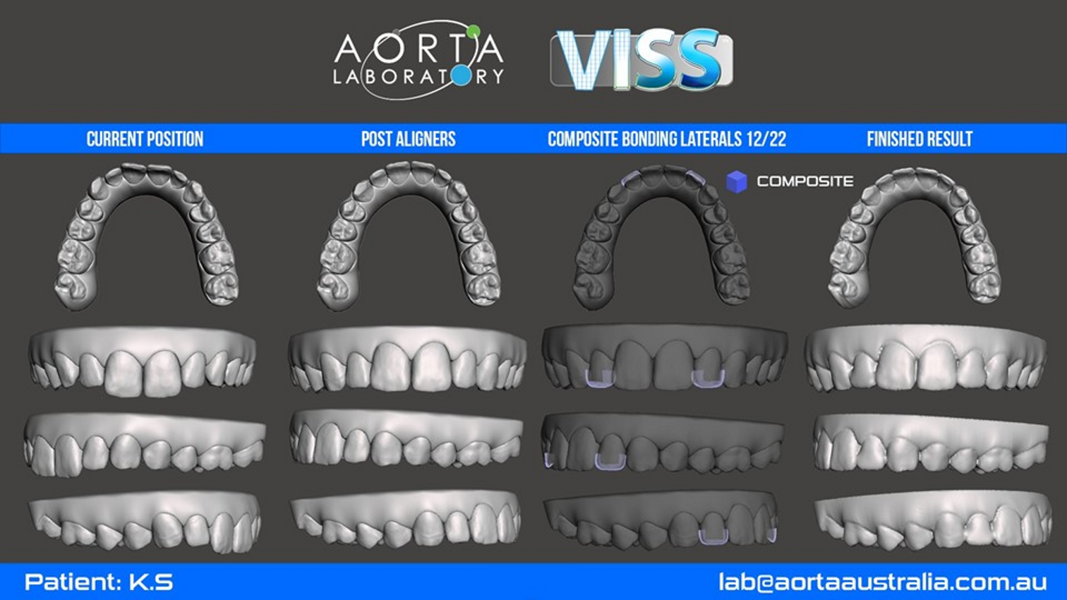 Fig. 49: Simulated VISS images showing the situation pretreatment, after aligner treatment and after direct restoration too (purple).