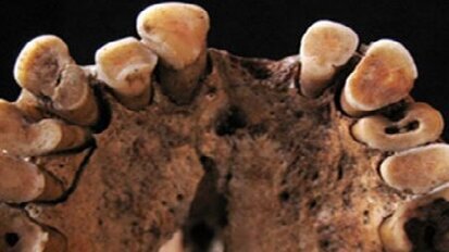 Ook jagers-verzamelaars hadden cariës