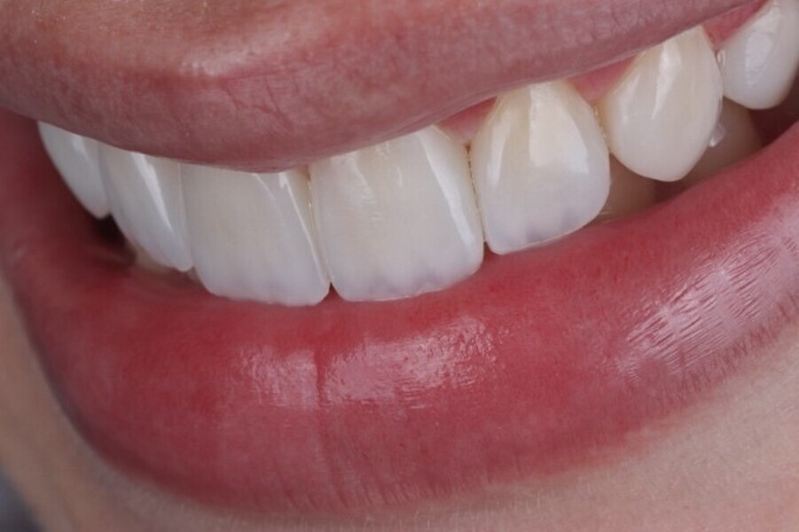 Fig. 3p: Side  profile view if the smile modification highlighting the natural life-like aesthetics achieved with the direct composite veneer restorations using the micd biological layering technique.