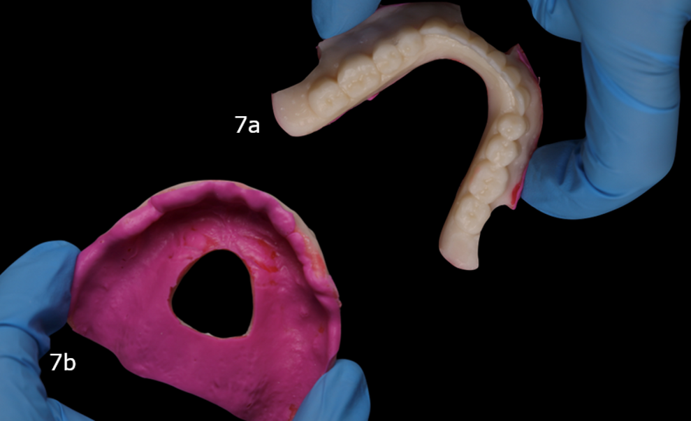 Figs. 7a & b: Relined maxillary (a) and mandibular trial prostheses (b). Cutouts in the prosthesis allow it to be scanned intra-orally with reference points.