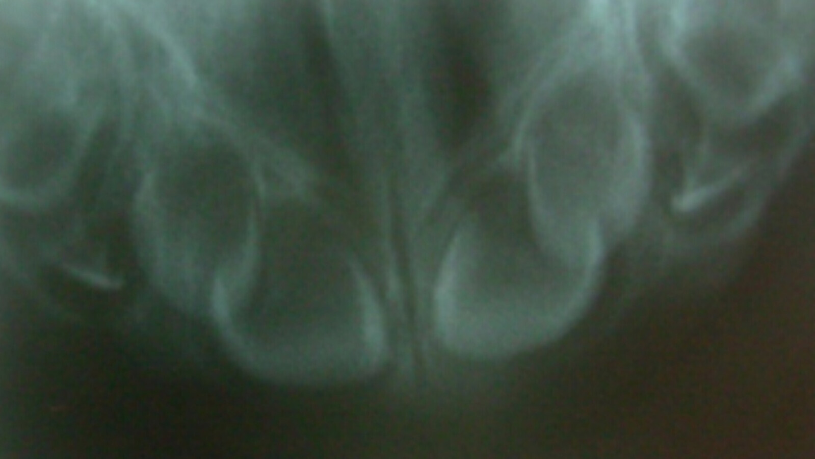 Figura n Â° 2. Vista radiogrÃ¡fica oclusal de zona anterior superior, bordeando el momento de erupciÃ³n de 51 y 61, donde se aprecia el apiÃ±amiento dentario (normal).
