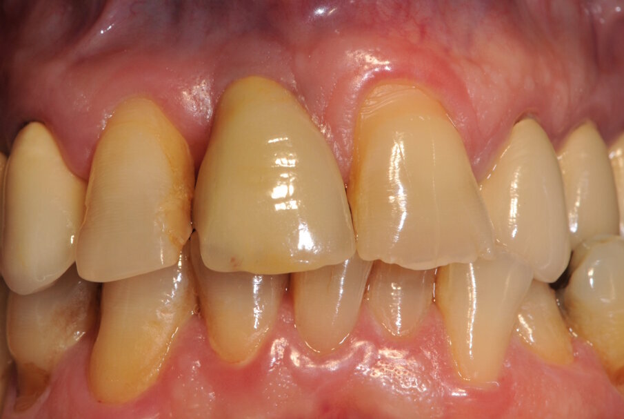 Fig. 14_ Corona definitiva a 4 anni dalla cementazione. Notare la stabilizzazione dei tessuti molli.