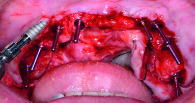 Incorporating CAD/CAM solutions for full-mouth dental implant reconstructions