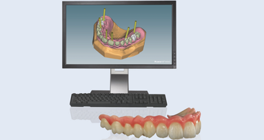 Creación segura, rápida y sencilla de puentes sobre implantes