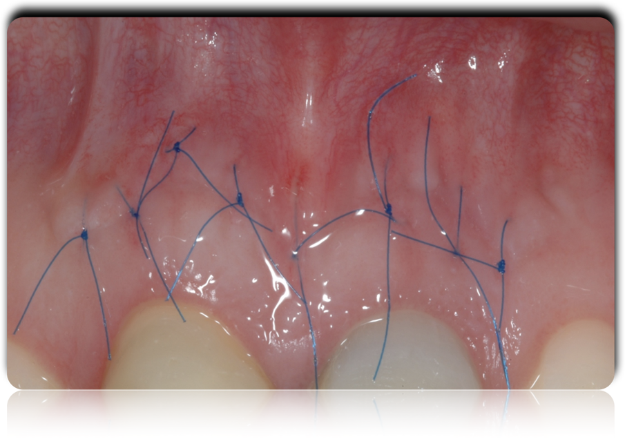 Figg. 9-11 - Fasi dell’apicectomia eseguita in attesa della completa maturazione dei tessuti parodontali.