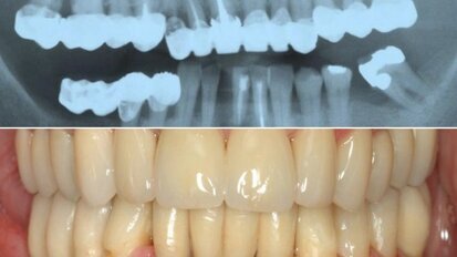 Експерт обяснява напредъка в имплантологията с помощта на дигиталните технологии