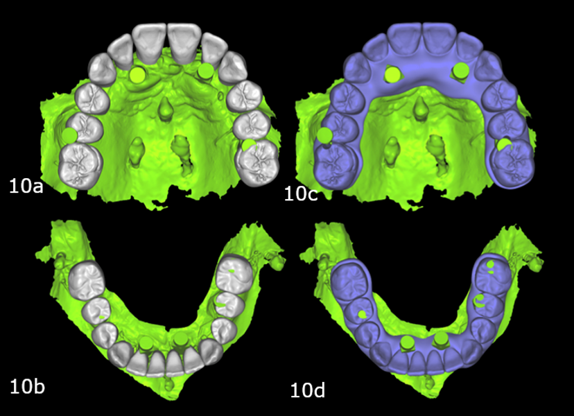 Figs. 10a–d: Original digital wax-up overlayed on to the implant scan (a & b). Conversion prostheses designed by connecting the teeth to the implants (c & d).