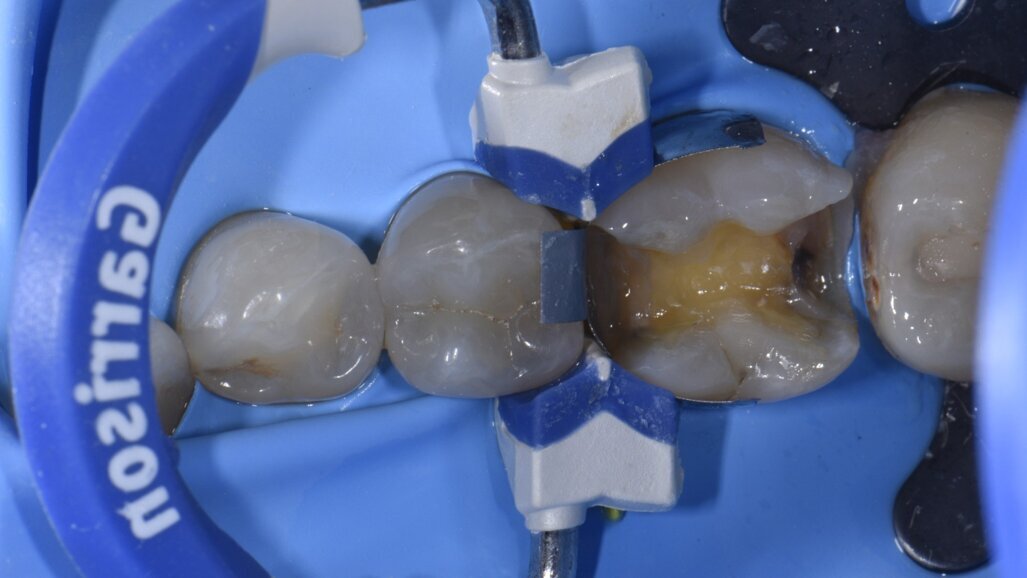 Controllo del contatto prossimale con sistema Garrison Composi-Tight 3D Fusion Sectional Matrix