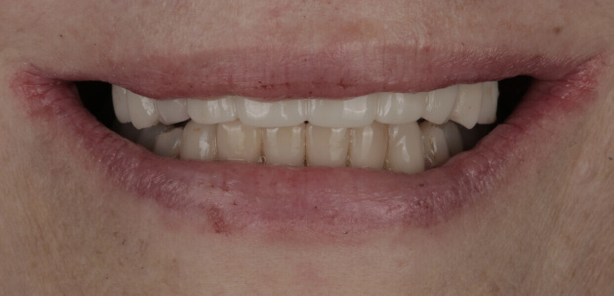 Fig. 16a: Provisional prosthesis on the day of implant surgery. Frontal view. 
