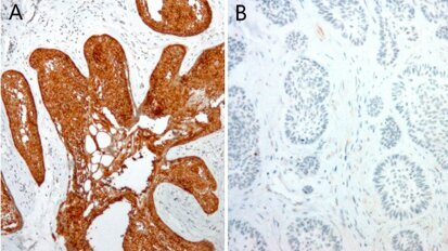 Pesquisadores encontram mutação em tumor do maxilar