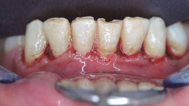 Interdyscyplinarne podejście do stosowania lasera Er,Cr:YSGG – leczenie estetyczne tkanek twardych i miękkich