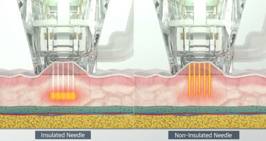 Sinergia rigenerativa in medicina estetica: RF-Needling, esosomi, peptidi  e i potenziali effetti sui telomeri