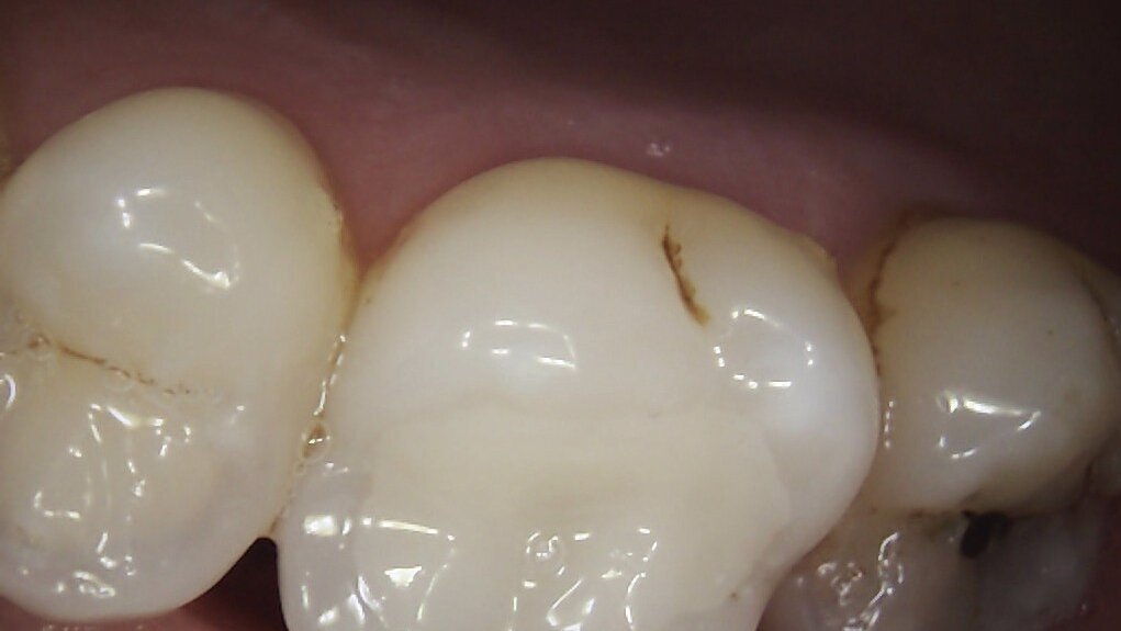 Removal of leaking amalgam restorations and placement of ceramic CAD/CAM inlays in one-hour