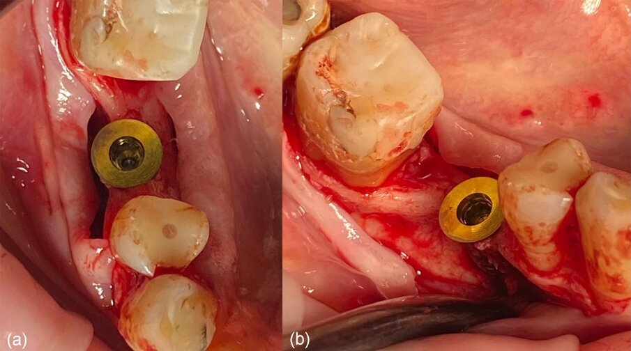 Fig. 7_Moncone di connessione in situ: a) vista occlusale, b) vista vestibolare.