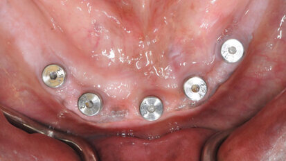 Restoring the edentulous arch with BruxZir full-arch implant prosthesis
