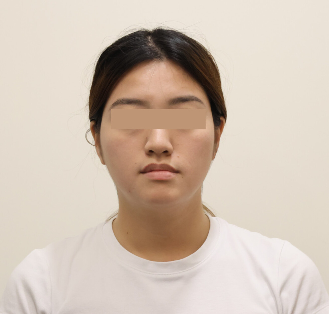Figs. 11a–c: Final extra-oral photographs.