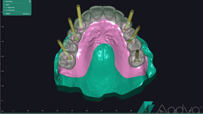 Fabrication of a long-term prototype to develop and sculpt anterior gingival tissue