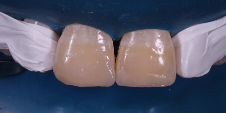 Fig 12: Second layer of Body Shade composite 