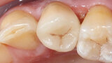 Fig. 13. Vista oclusal de la endocorona colocada de forma totalmente adhesiva.