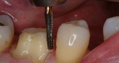 Nouveau paradigme pour la préparation de la couronne : les fraises carbure Great White Ultra (GWU)