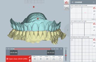 Figg. 9a-9d_La posizione di occlusione abituale, in visione frontale (a) e laterale (b). La posizione terapeutica ottenuta dopo la pianificazione digitale, riposizionando i condili in avanti e in basso e ricentrando la linea mediana, in visione frontale (c) e laterale (d). La posizione terapeutica è stata pianificata in tempo reale durante il check-up diagnostico 
della paziente, con un flusso di lavoro one-day completamente digitale