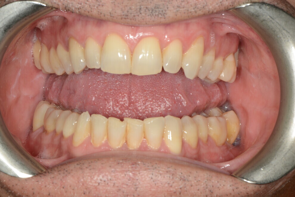 Fig. 7: Tongue indentations due to vacuum effect during atypical swallowing.