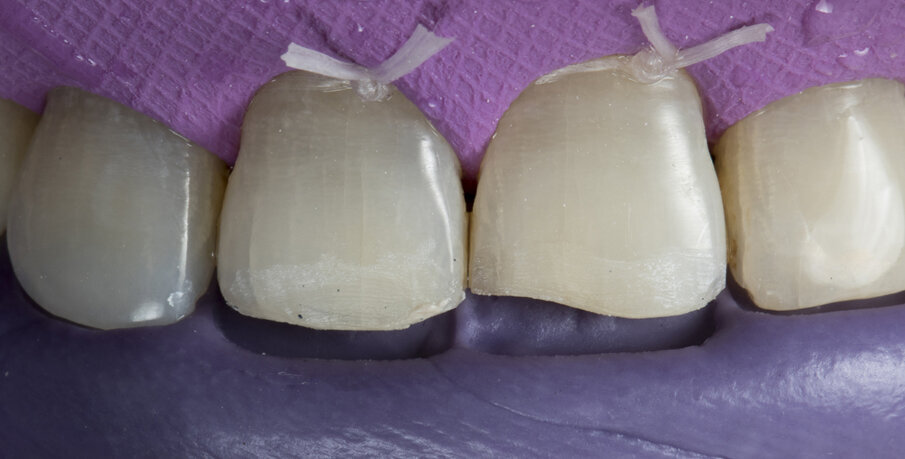 Fig. 7: Putty index checked intra orally after placing rubber dam