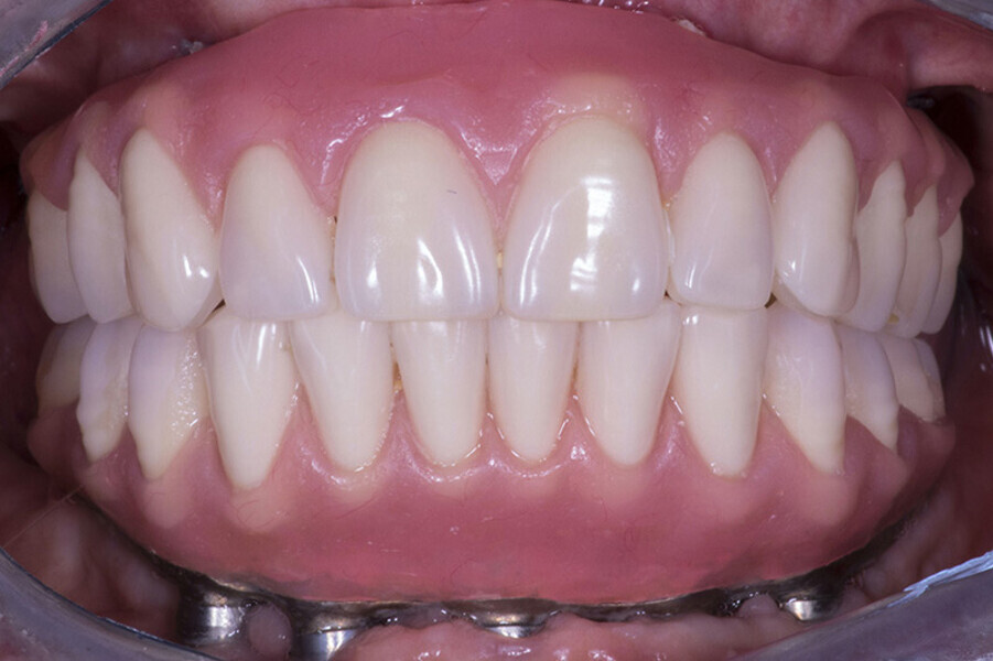 Fig. 19. Prótesis híbrida inmediata con 7 años de evolución y Rx Control a los 7 años.